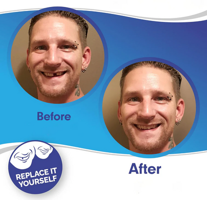 Full Dental Veneer Kit – Upper & Lower Cosmetic Covers