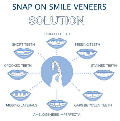 Full Dental Veneer Kit – Upper & Lower Cosmetic Covers