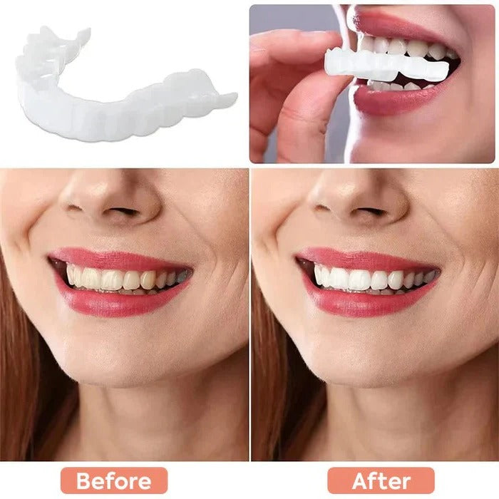 Clip On Cosmetic Veneers and Temporary Tooth Covers