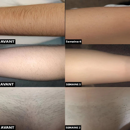 Rechargeable Light Pulse Hair Removal Device